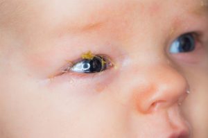 أسباب إفرازات العين عند الأطفال الرضع
