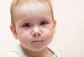 صورة أسباب احمرار عين المولود وطرق العلاج