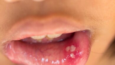 صورة أسباب تقرحات الفم عند الرضع والأطفال وطرق العلاج والوقاية