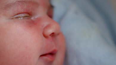 صورة رمد العين عند حديثي الولادة.. أسبابه وطرق العلاج والوقاية